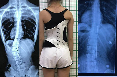 3D打印技術(shù)在骨科的實際應(yīng)用有哪些？(圖4)